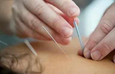 Dłonie terapeuty wykonują akupunkturę, wkłuwając cienkie igły w plecy pacjenta.